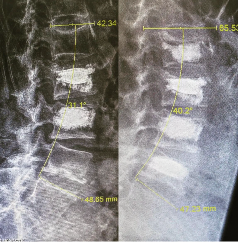 Αποκατάσταση σπονδυλικής στήλης