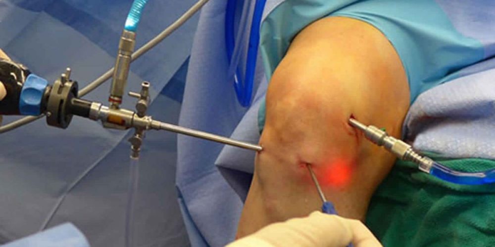 Αρθροσκόπηση γονάτου