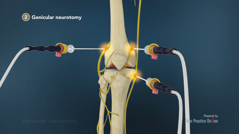 Νευροτροποποιηση