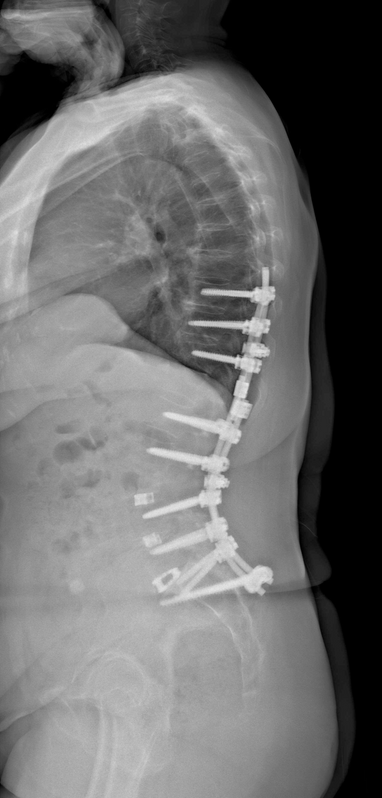 Αποκατάσταση σπονδυλικής στήλης