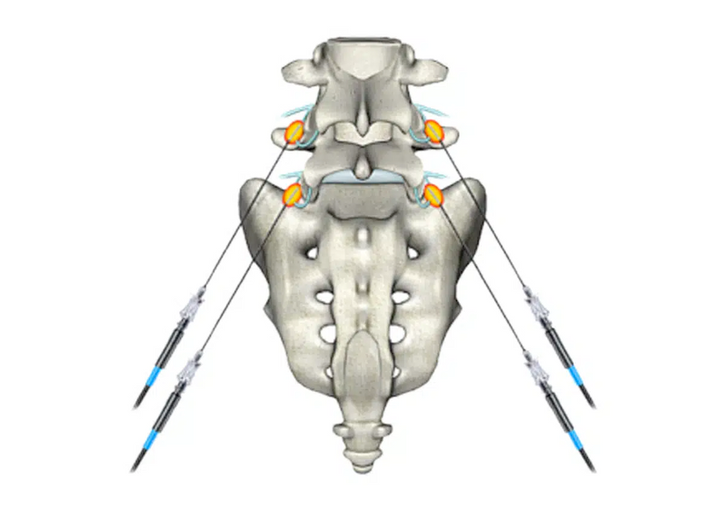 Νευροτροποποιηση